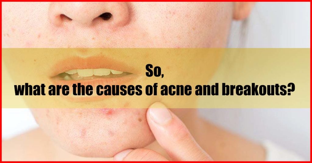 What are the causes of acne and breakouts